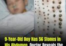 9-Year-Old Boy Found With 56 Stones in His Abdomen — Doctor Reveals the Cause, Mother Breaks Down After Learning It Was Something She Gave Him Every Day