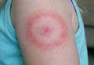 My Child Woke Up With a Red Ring on Her Arm—What Could It Mean?