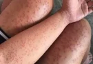 Skin Rash With Breathing Trouble? It Could Be a Life-Threatening Allergic Reaction